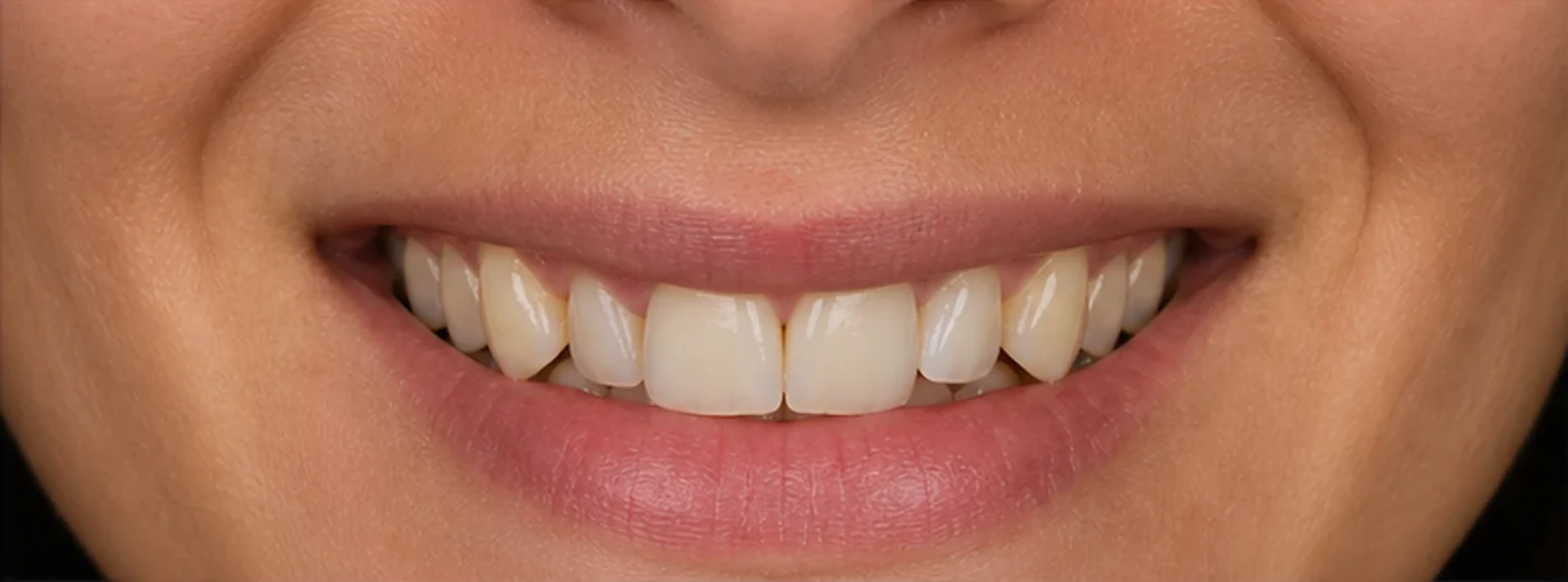 Sonrisa antes de la ortodoncia invisible