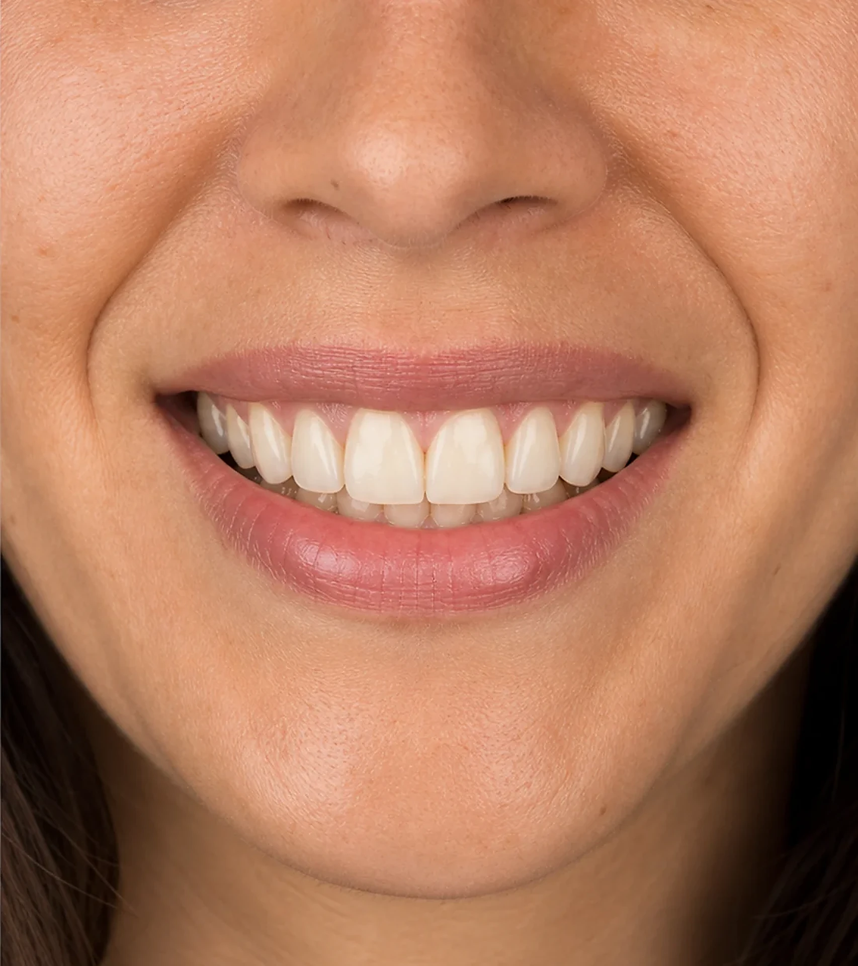 La misma sonrisa tras el tratamiento, alineada y de aspecto natural