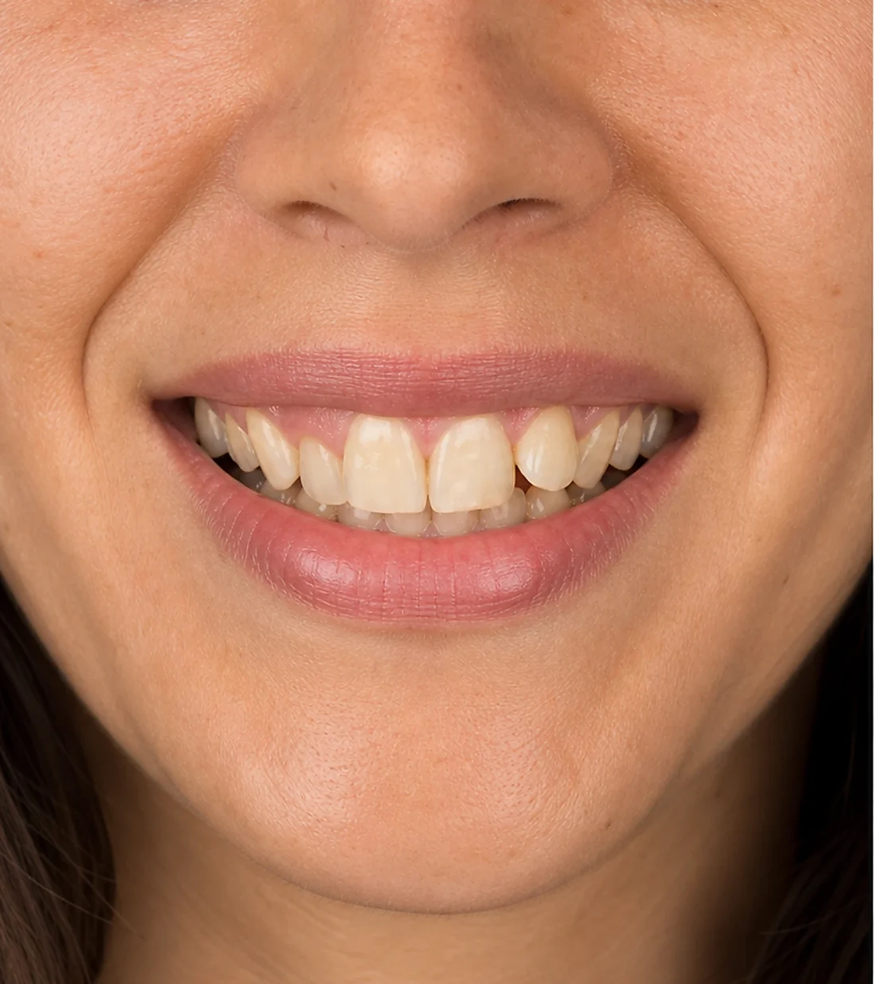 Sonrisa antes del tratamiento con apiñamiento, tinción y bordes irregulares