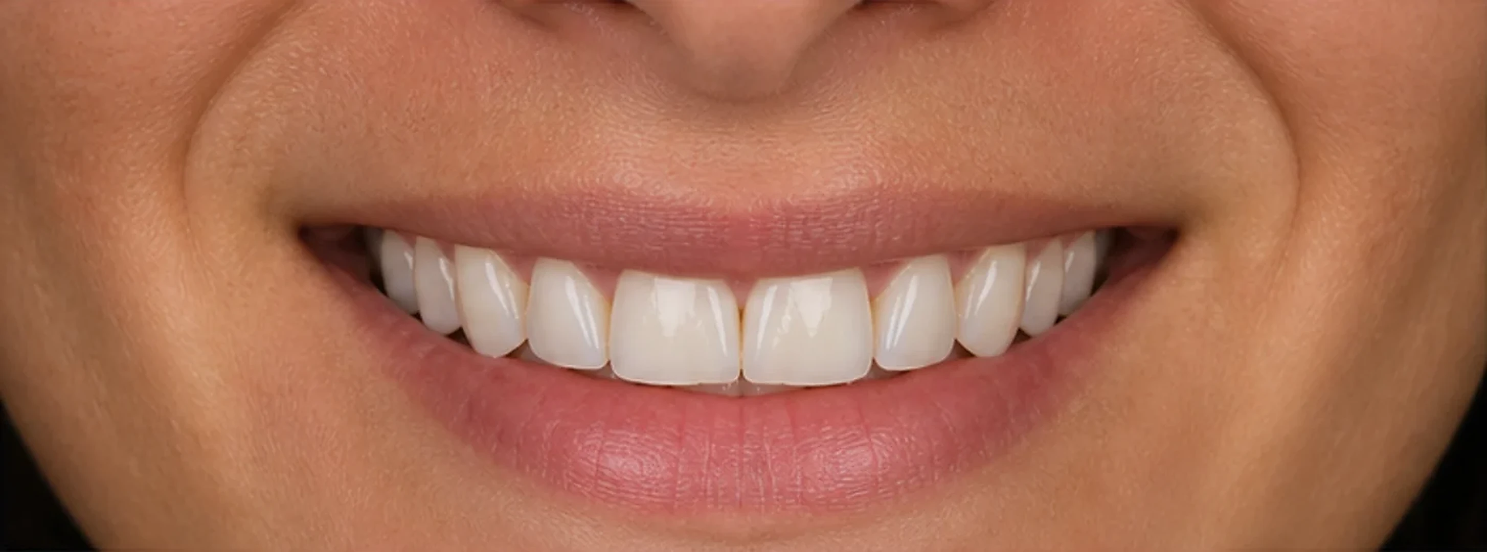 La misma sonrisa después del blanqueamiento dental