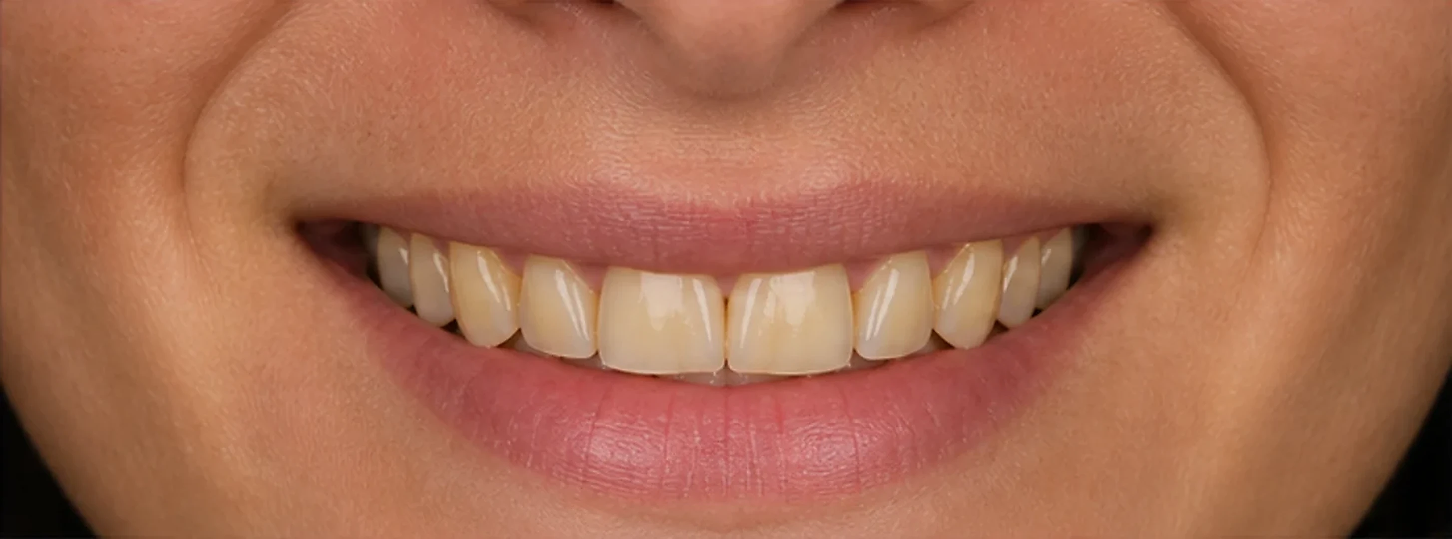 Sonrisa antes del blanqueamiento con tinción visible