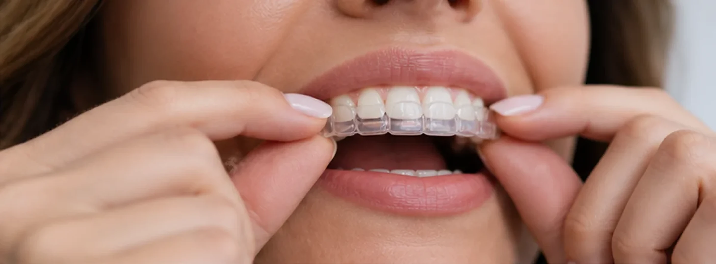 Alineador transparente colocado sobre una sonrisa natural