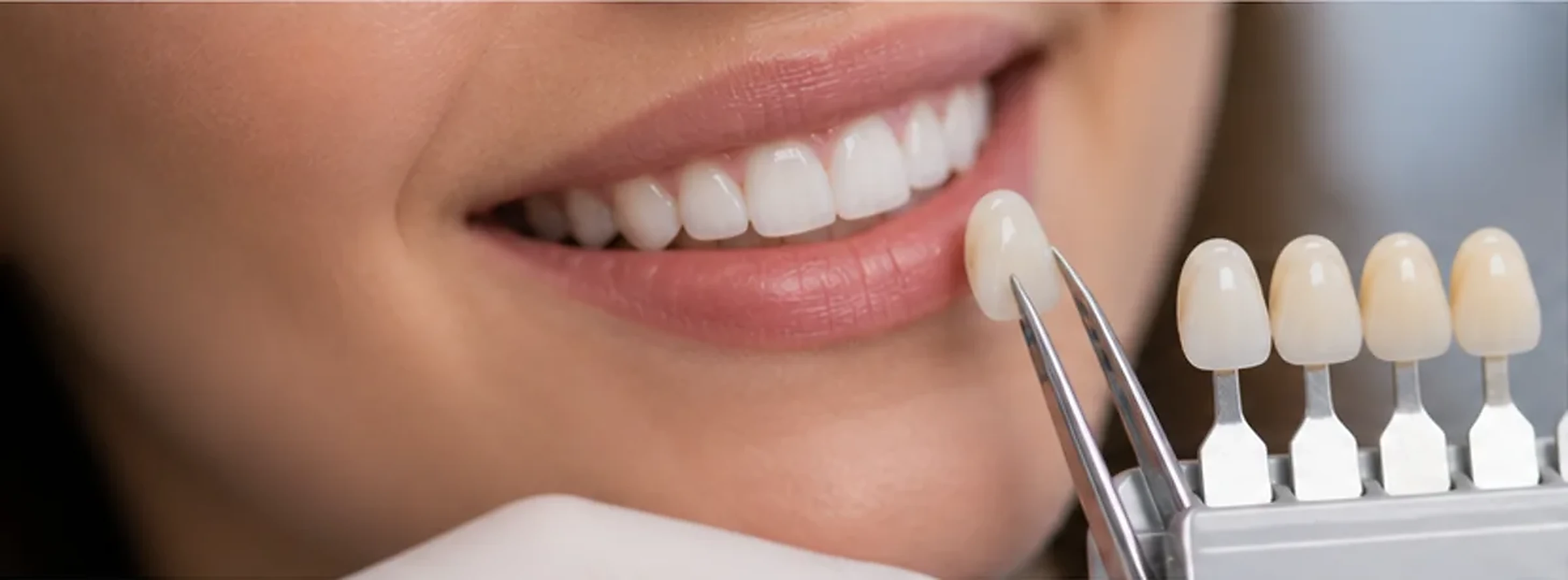 Selección de carillas cerámicas y tono dental